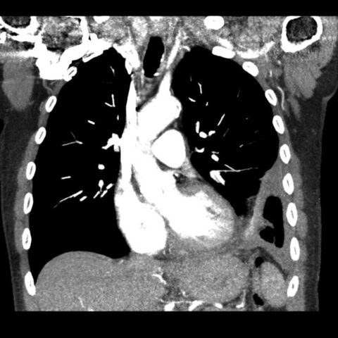 Case Report of an Empyema Identified on Lung Ultrasound - JETem