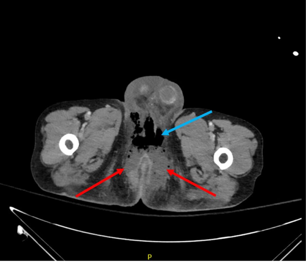 Fournier s Gangrene CT Annotated JETem 2022 JETem fournier-s-gangrene-ct-annotated-jetem-2022-jetem