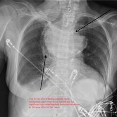 A Case Report of a Large Goiter Resulting in Tracheal Deviation - JETem