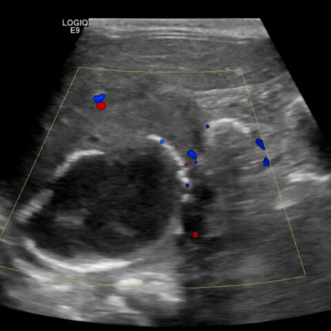 A Case Report of Neonatal Vomiting due to Adrenal Hemorrhage, Abscess ...