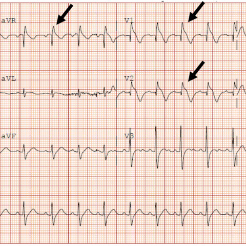 Case Report—Pediatric Brugada Phenotype from Accident Cocaine Ingestion ...