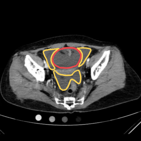 An Atraumatic, Idiopathic Case Report of Intraperitoneal Bladder Dome ...