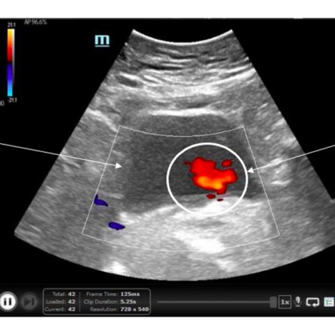 Ureteral Obstruction and Ureteral Jet Identification—A Case Report - JETem