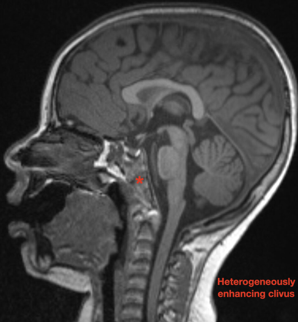 Toddler with Metastatic Neuroblastoma. T1 Sagittal MRI Clivus Annotated ...