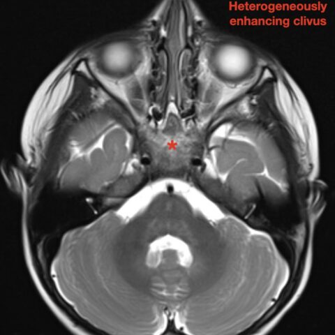 An Unusual Case Report of a Toddler with Metastatic Neuroblastoma ...