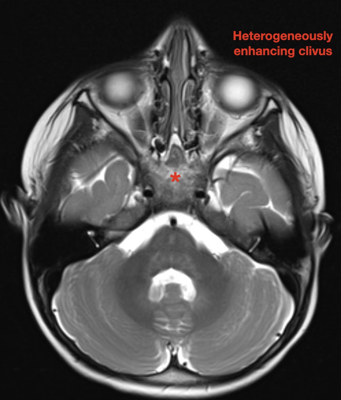 Toddler with Metastatic Neuroblastoma. T2 Axial MRI Clivus Annotated ...