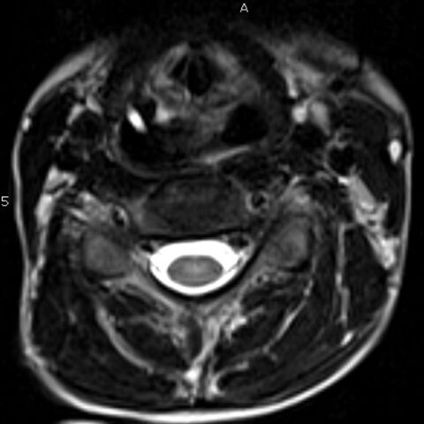 Clinical and Radiologic Features of Fulminant Pediatric Autoimmune ...