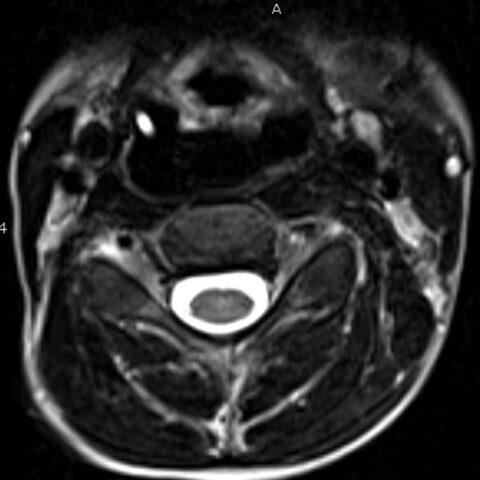 Clinical and Radiologic Features of Fulminant Pediatric Autoimmune ...