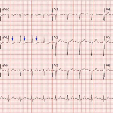 ‘Cath’ It Before It’s Too Late: A Case Report of ECG Abnormalities ...