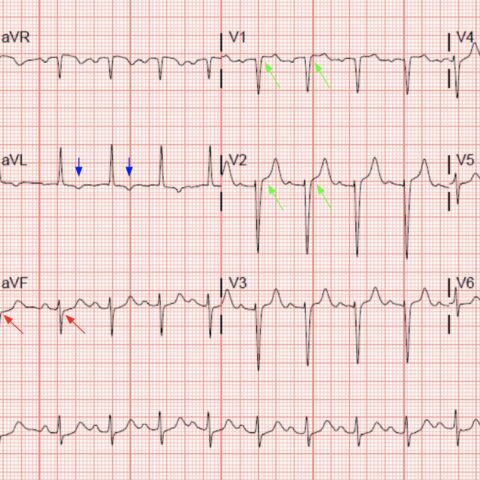 ‘Cath’ It Before It’s Too Late: A Case Report of ECG Abnormalities ...