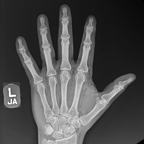 High-Pressure Injection Injury to the Hand - A Case Report - JETem