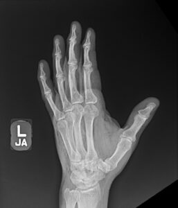 High-Pressure Injection Injury. Hand XR 2. Unannotated. JETem 2022 - JETem