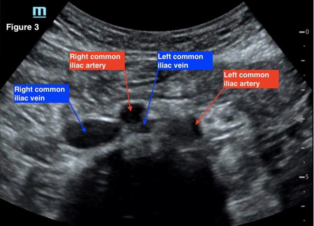 May Thurner. Transverse ultrasound of the abdomen using a curvilinear ...