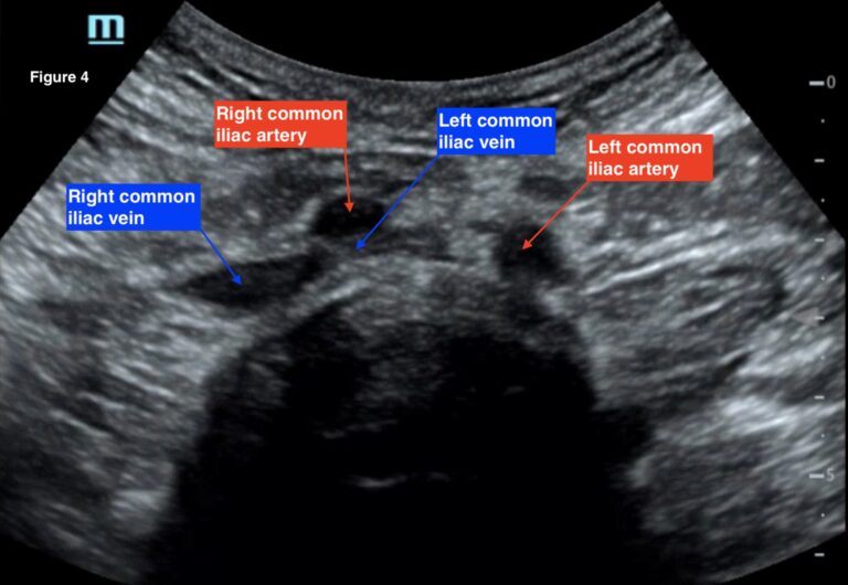 May Thurner. Transverse ultrasound of the abdomen with compression of ...