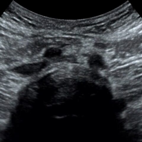 A Case Report of May-Thurner Syndrome Identified on Abdominal ...