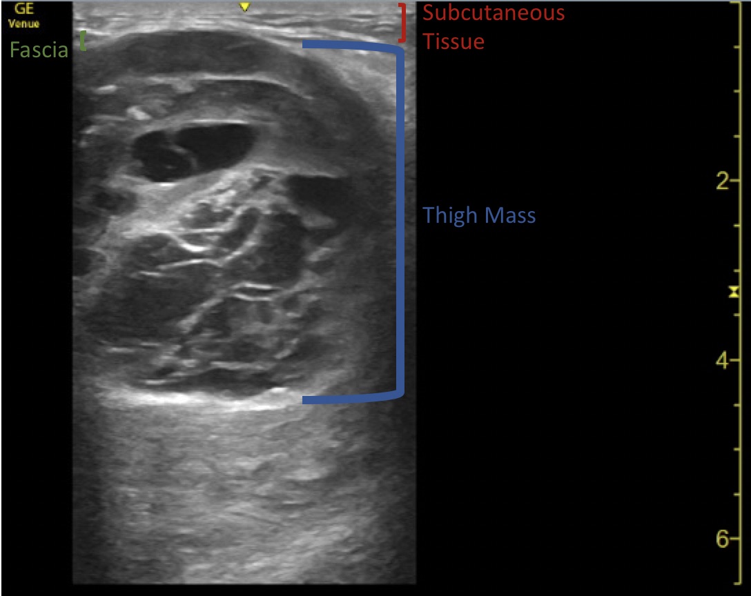 Thigh Mass Us Annotated Jetem 2022 Jetem