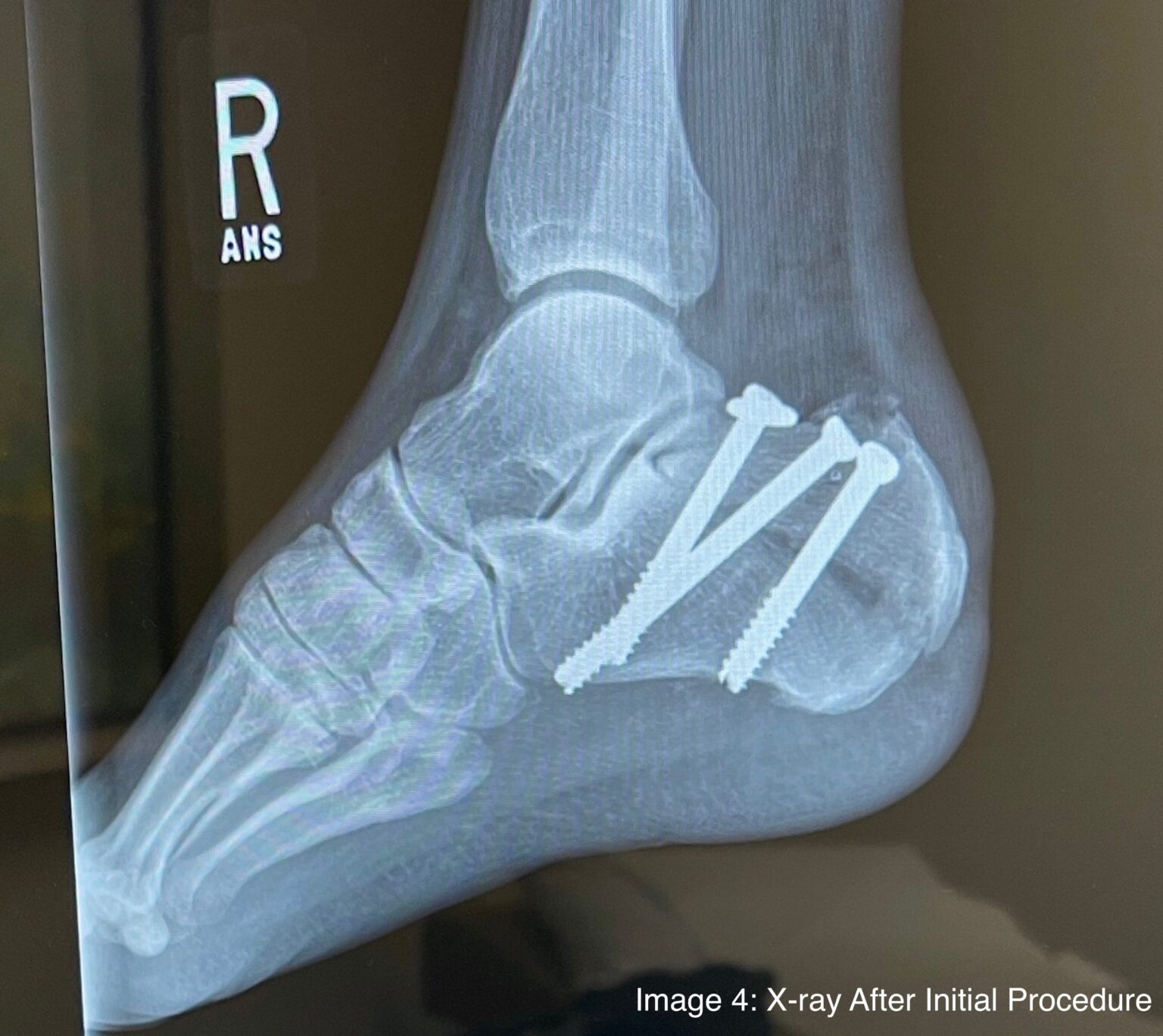 Tongue-Type Calcaneal Fracture Image 4 Annotated - JETem