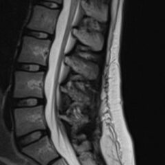 Acute Flaccid Myelitis - JETem