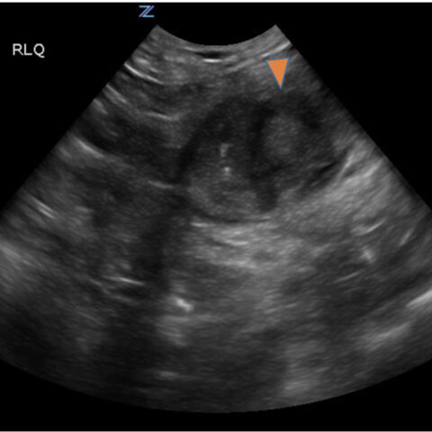 Imaging Findings of Small Bowel - Diverticulitis: A Case Report - JETem