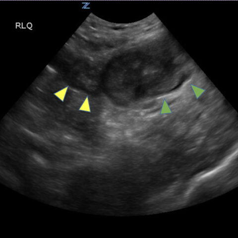 Imaging Findings of Small Bowel - Diverticulitis: A Case Report - JETem