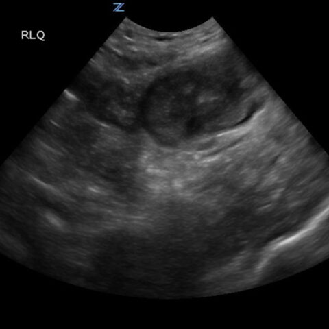 Imaging Findings of Small Bowel - Diverticulitis: A Case Report - JETem