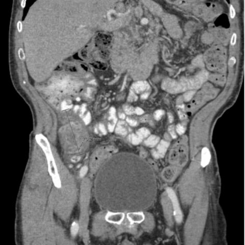 Imaging Findings Of Small Bowel - Diverticulitis: A Case Report - Jetem