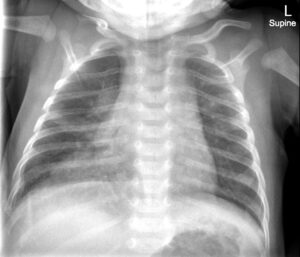 Infant Community-Acquired Tuberculosis. CXR AP. JETem 2023 - JETem