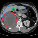 R Retroperitoneal Hematoma CT Annotated 1. JETem 2023