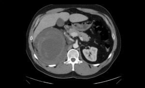 R Retroperitoneal Hematoma CT Unannotated 1. JETem 2023