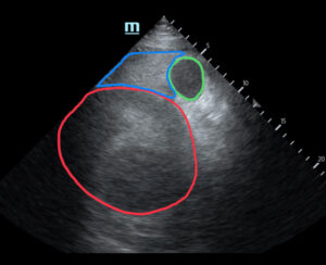 R Retroperitoneal Hematoma US 1 Annotated 2. JETem 2023