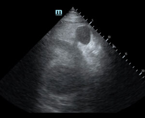 R Retroperitoneal Hematoma US 2 Unannotated. JETem 2023