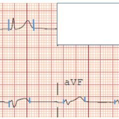 A Case Report of Subtle EKG Abnormalities in Acute Coronary Syndromes ...