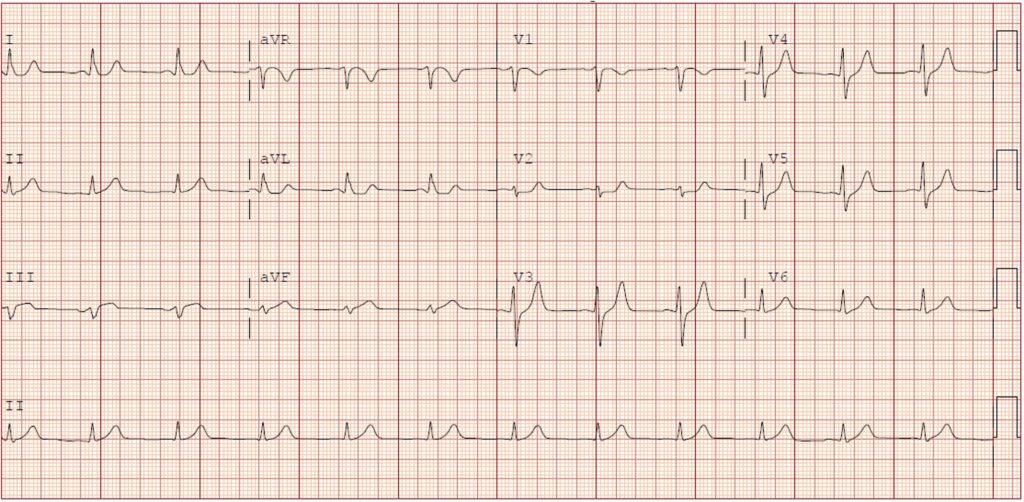 A Case Report of Subtle EKG Abnormalities in Acute Coronary Syndromes ...