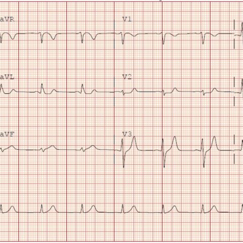 A Case Report of Subtle EKG Abnormalities in Acute Coronary Syndromes ...