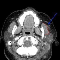 Case Report of Herpes Zoster Ophthalmicus with Concurrent Parotitis - JETem