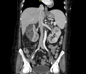 Emphysematous pyelonephritis. CT Coronal. JETem 2023