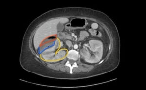 Emphysematous pyelonephritis. CT Transverse Annotated. JETem 2023