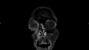 Mucormycosis. MRI 1. JETem 2023