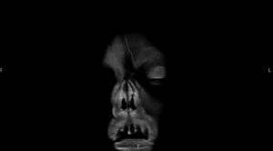 Mucormycosis. MRI 2. JETem 2023