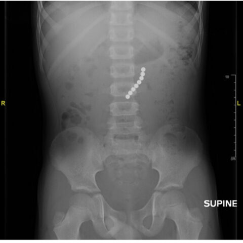 Point-Of-Care Ultrasound Use for Detection of Multiple Metallic Foreign ...