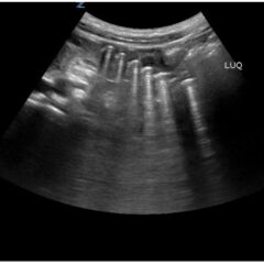 Point Of Care Ultrasound Use for Detection of Multiple Metallic Foreign Body Ingestion. US. JETem 2023