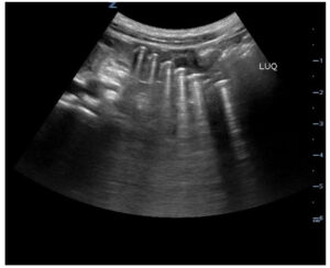 Point Of Care Ultrasound Use for Detection of Multiple Metallic Foreign Body Ingestion. US. JETem 2023