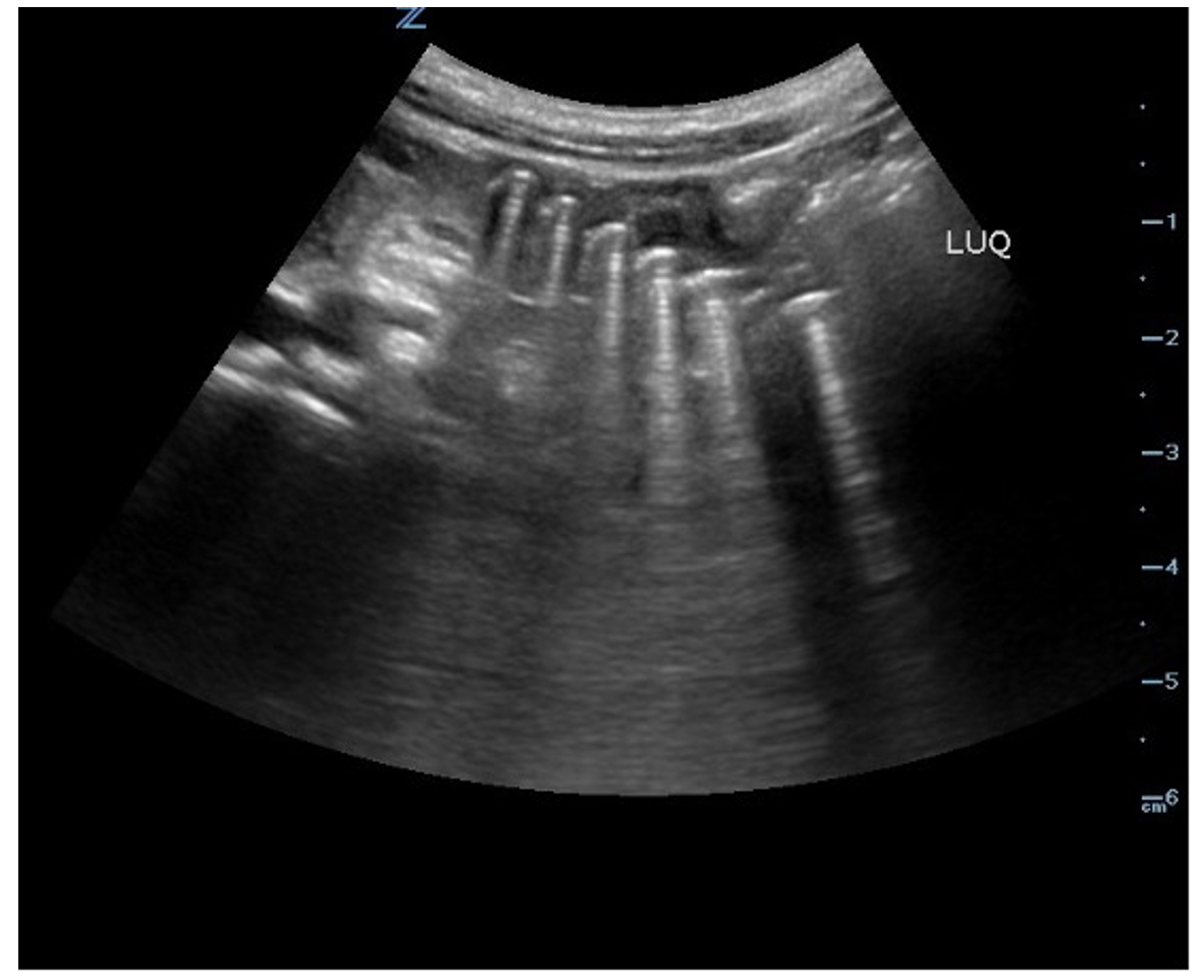 Point Of Care Ultrasound Use For Detection Of Multiple Metallic Foreign 