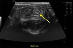 Colocolic Intussusception. Abdominal Ultrasound Annotated. JETem 2024