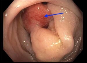 Colocolic Intussusception. Colonoscopy Annotated. JETem 2024