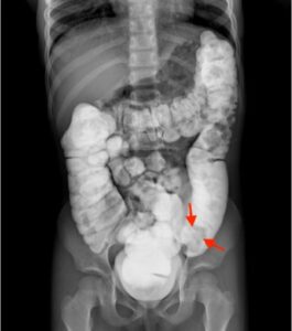 Colocolic Intussusception. Contrast Enema Annotated. JETem 2024