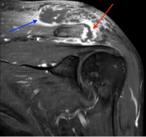 Septic Arthritis of AC Joint. MRI Coronal. Annotated. JETem 2024