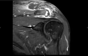 Septic Arthritis of AC Joint. MRI Coronal. Unannotated. JETem 2024