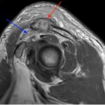 Septic Arthritis of AC Joint. MRI Sagittal. Annotated. JETem 2024