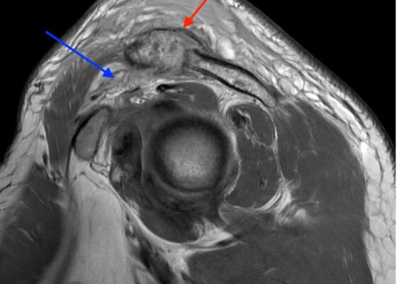 Septic Arthritis of AC Joint. MRI Sagittal. Annotated. JETem 2024
